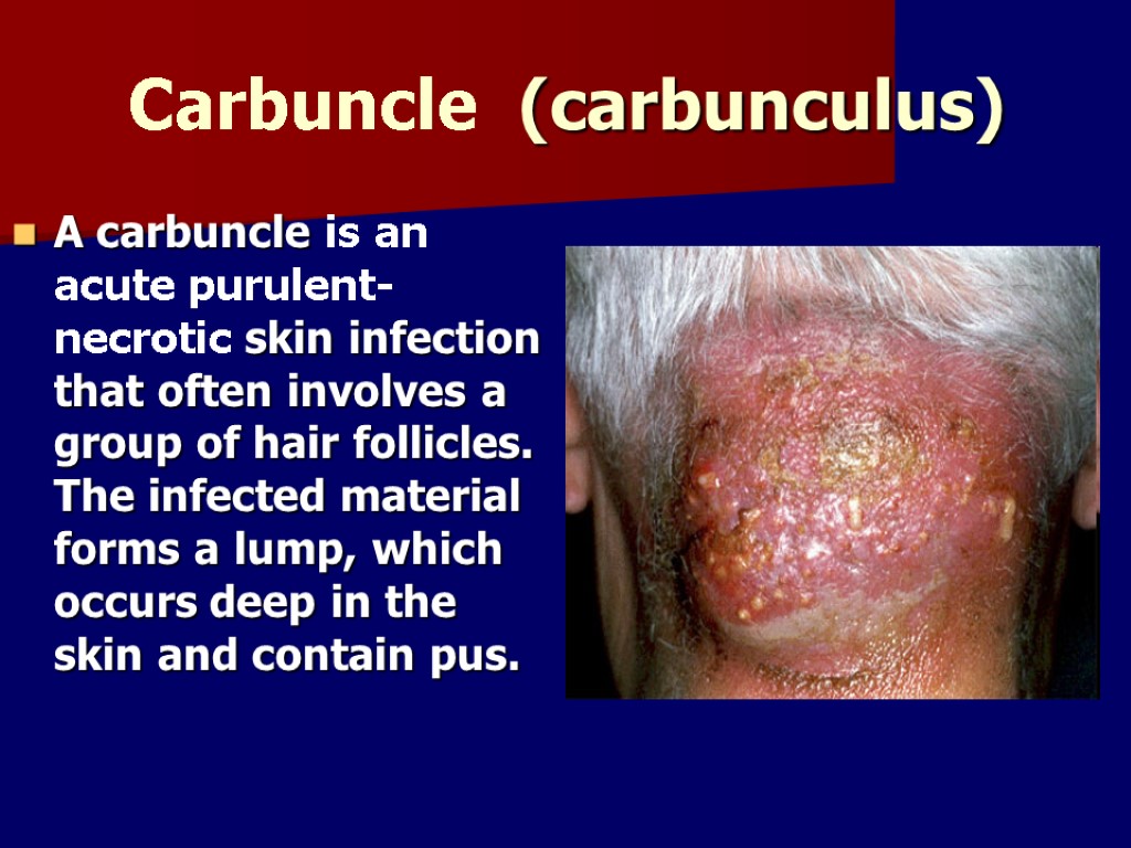 Carbuncle (саrbunculus) A carbuncle is an acute purulent-necrotic skin infection that often involves a